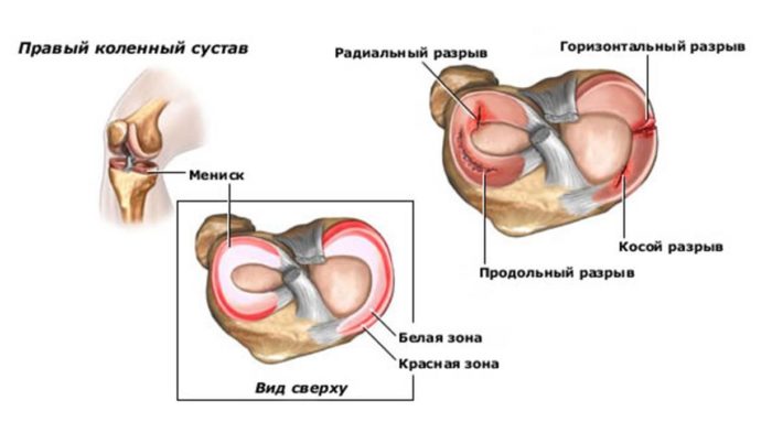 Фото 10: Почему болит под коленом сзади? Причины боли и…